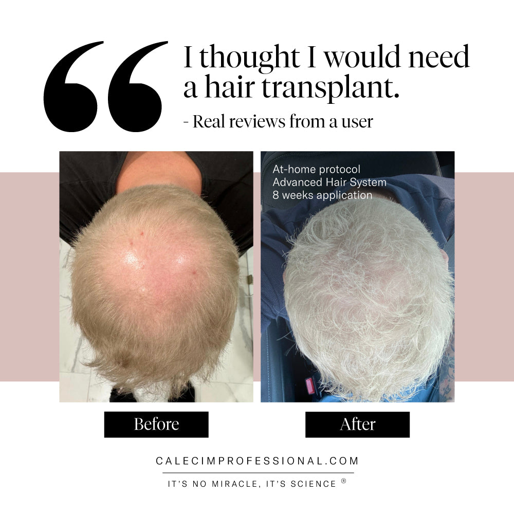 Calecim Advanced Hair System | Rosser Hair